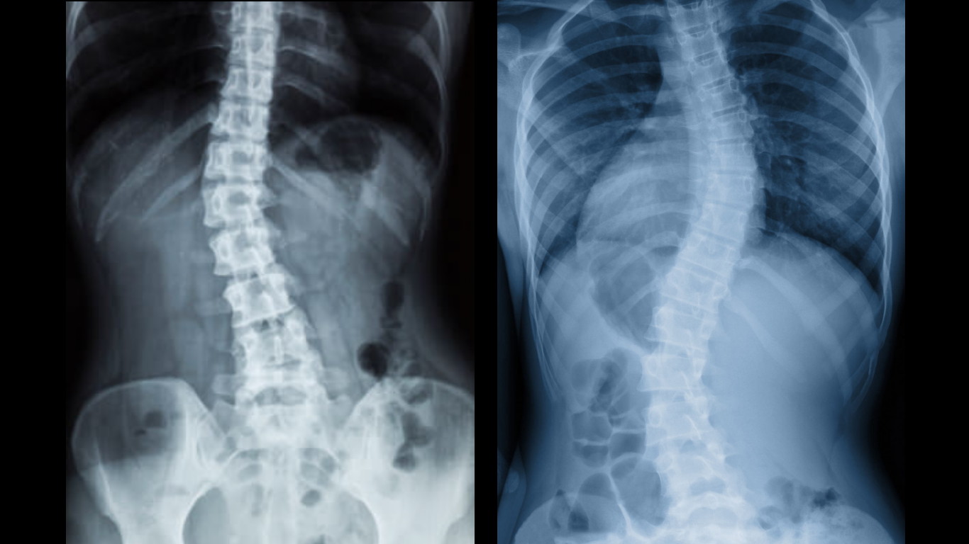 Scoliosis C curve S curve