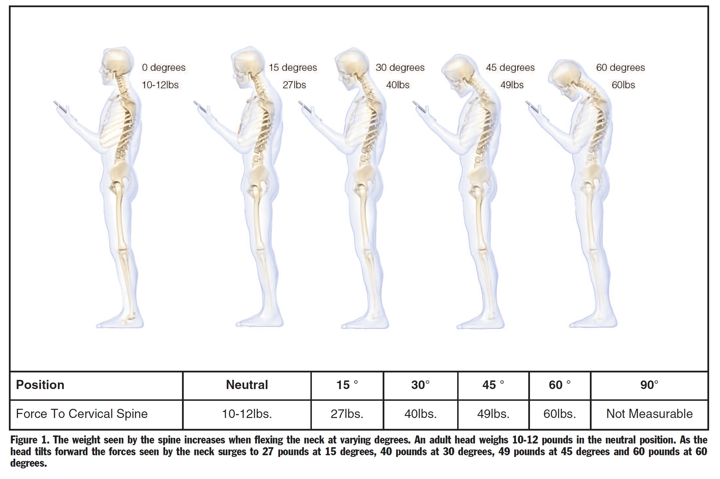 forward head posture neck hump