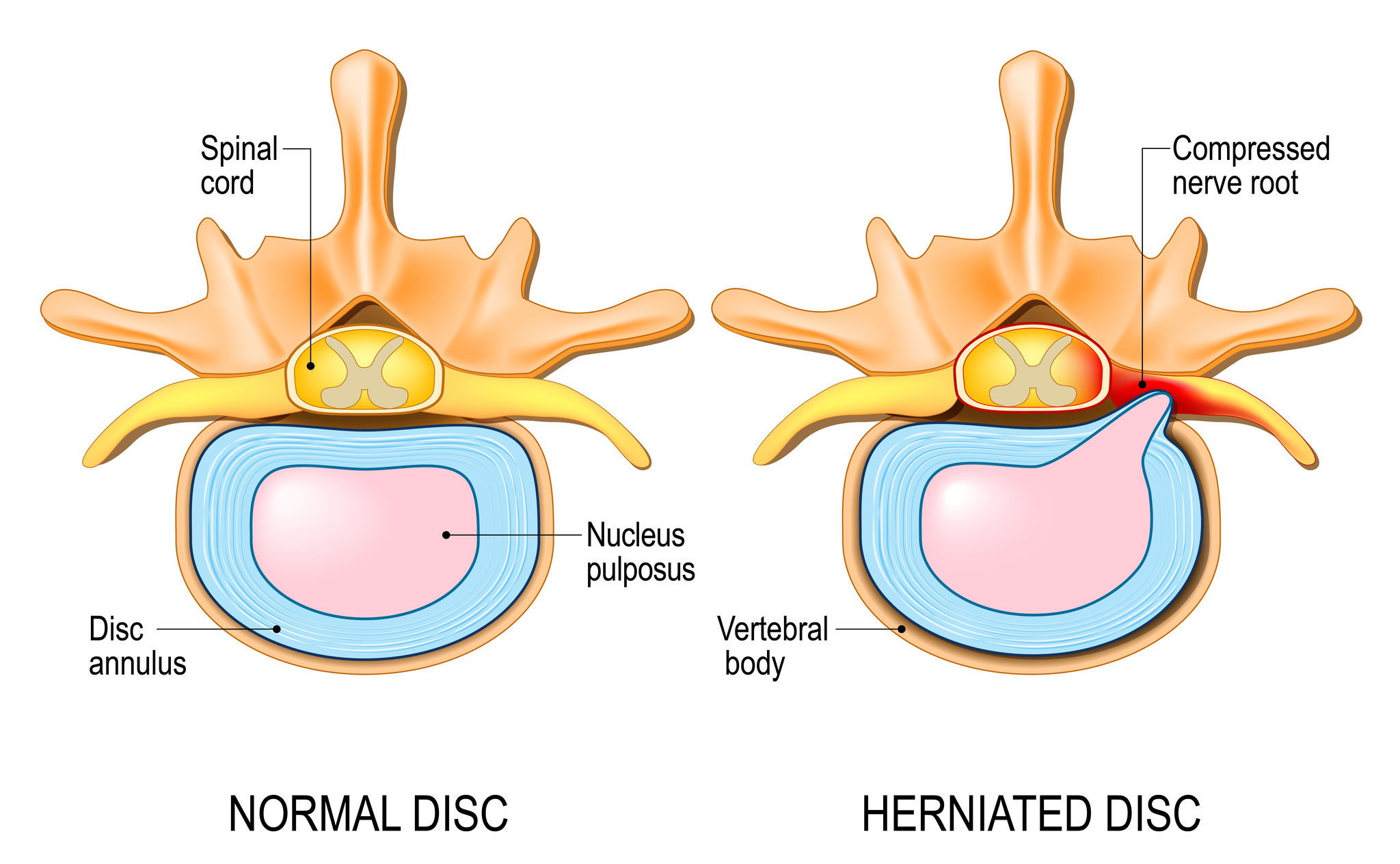 spinal degeneration