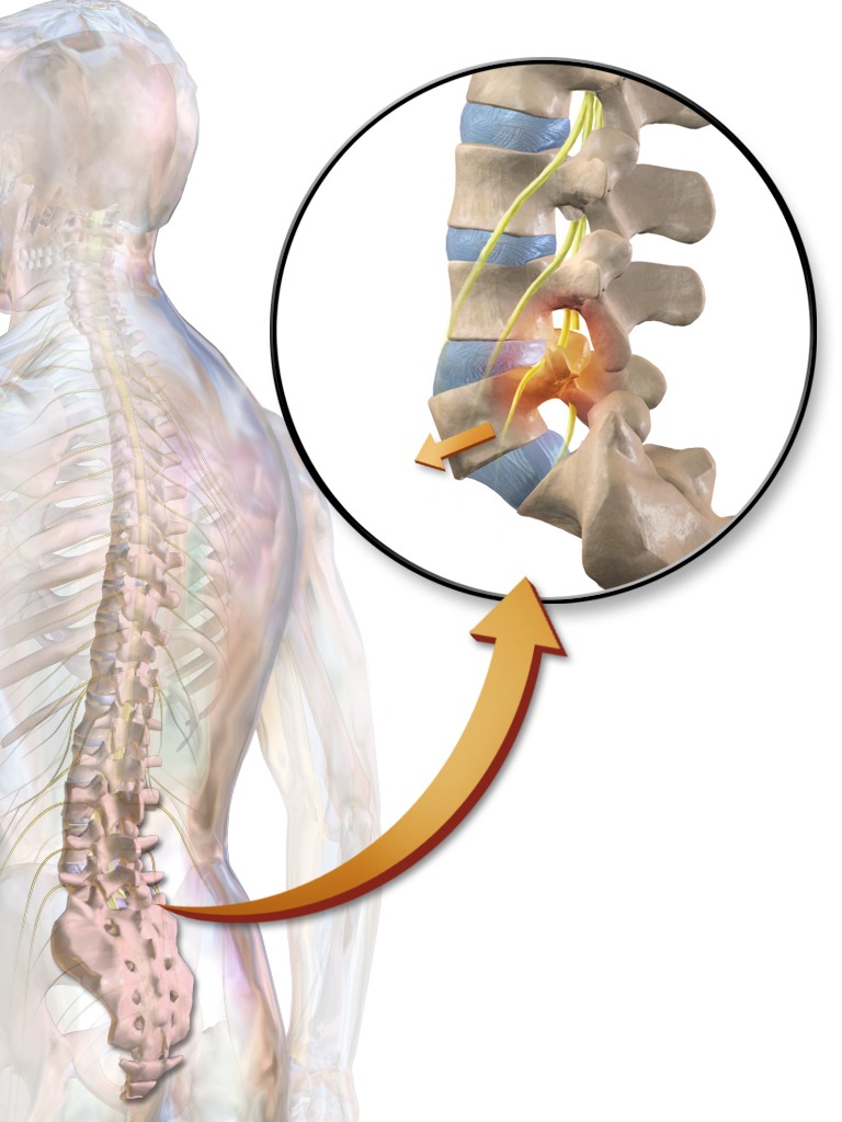 Spondylolisthesis