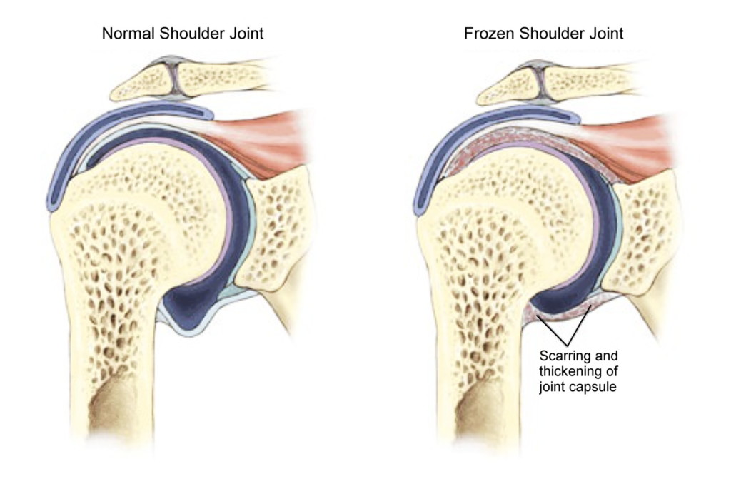 What A Frozen Shoulder Looks Like