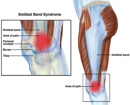 6 Great Iliotibial Band Stretches for Tight ITB - Knee Pain Explained