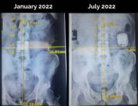Somatics Before and After