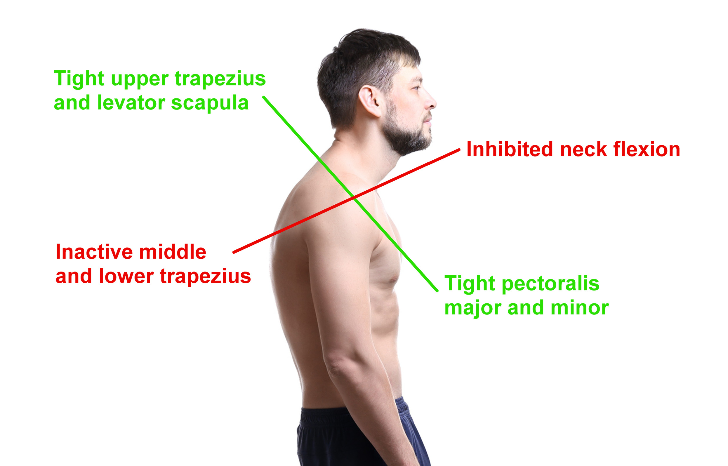 Upper Crossed Syndrome Somatic Movement Center